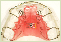 歯とあごのバランスを整える取り外し可能な矯正装置